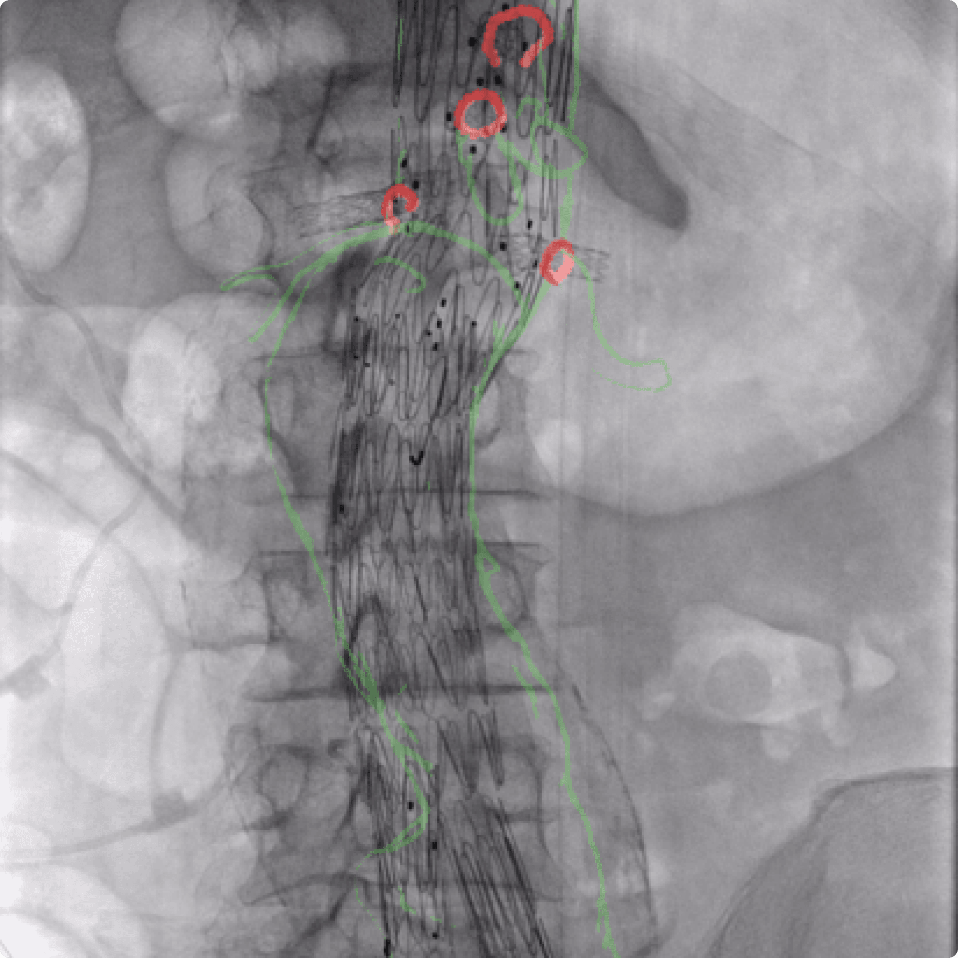 X-ray image from endovascular surgery