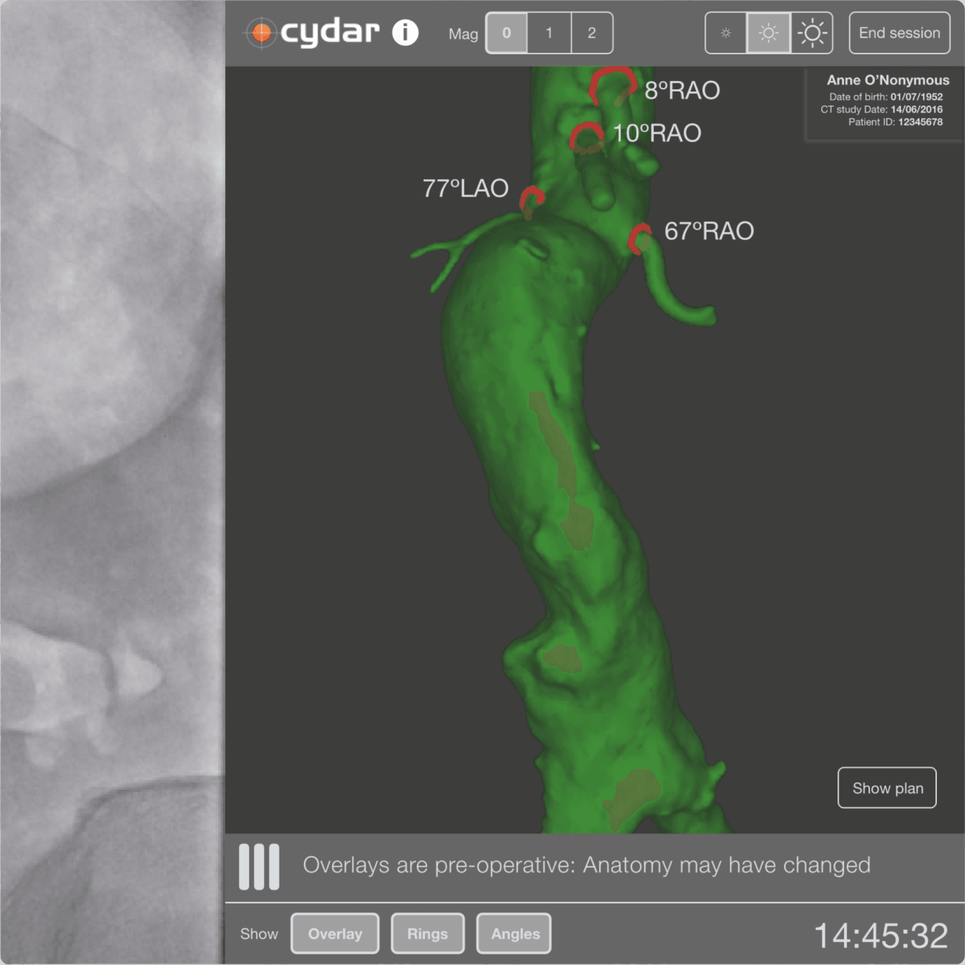 3D imagery from endovascular surgery