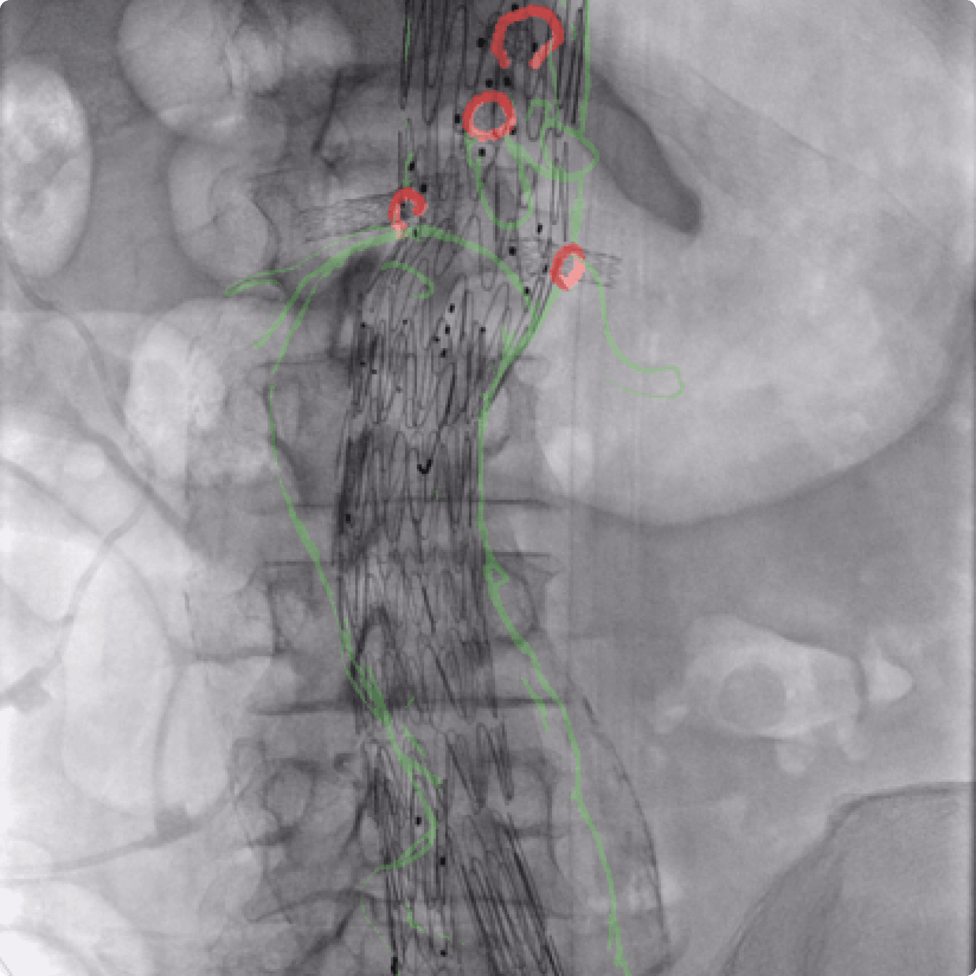 X-ray image from endovascular surgery X-ray image from endovascular surgery