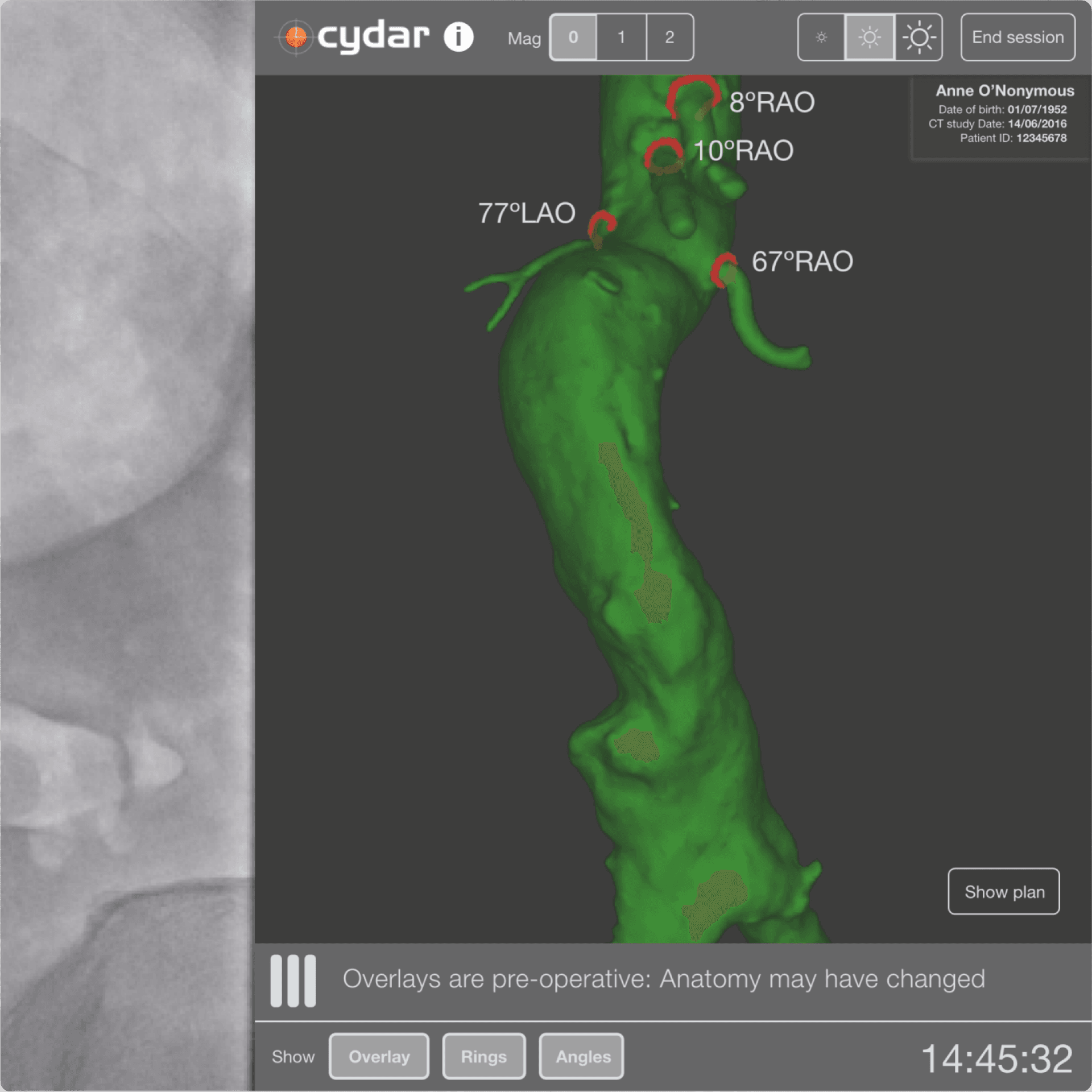 3D imagery from endovascular surgery 3D imagery from endovascular surgery